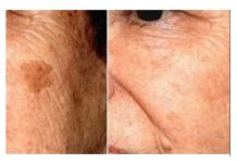 POZNATI DERMATOLOG OTKRIO: Ovo je uloga sode bikarbone u liječenju mrlja na licu! POZNATI DERMATOLOG OTKRIO: Ovo je uloga sode bikarbone u liječenju mrlja na licu! - featured image