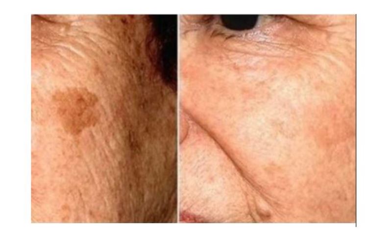 POZNATI DERMATOLOG OTKRIO: Ovo je uloga sode bikarbone u liječenju mrlja na licu! - featured image POZNATI DERMATOLOG OTKRIO: Ovo je uloga sode bikarbone u liječenju mrlja na licu! - featured image