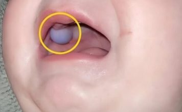 Majka je primetila nešto neobično u ustima svog devetomesečnog sina i odmah je otišla kod lekara — otkriće lekara bilo je iznenađujuće. Majka je primetila nešto neobično u ustima svog devetomesečnog sina i odmah je otišla kod lekara — otkriće lekara bilo je iznenađujuće. - featured image