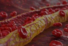 Ovi znaci na nogama pokazuju da imate izuzetno visok holesterol: Ne smijete ih ignorisati, posljedice su fatalne po tijelo Ovi znaci na nogama pokazuju da imate izuzetno visok holesterol: Ne smijete ih ignorisati, posljedice su fatalne po tijelo - featured image