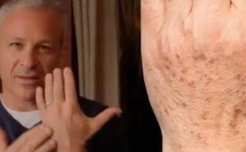 Sok od luka + jabukovo sirće: Samo pomiješajte i riješite se staračkih pjega narukama, licu i dekolteu jednom za svagda!