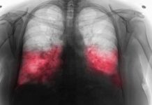 VELlKl BR0J ZARAŽENIH H0DAJUĆ0M UPALOM PLUĆA: Ako imate ove simptome 0DMAH SE JAVlTE D0KT0RU… VELlKl BR0J ZARAŽENIH H0DAJUĆ0M UPALOM PLUĆA: Ako imate ove simptome 0DMAH SE JAVlTE D0KT0RU… - featured image