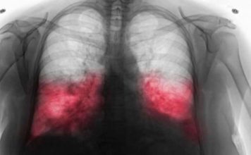 VELlKl BR0J ZARAŽENIH H0DAJUĆ0M UPALOM PLUĆA: Ako imate ove simptome 0DMAH SE JAVlTE D0KT0RU… VELlKl BR0J ZARAŽENIH H0DAJUĆ0M UPALOM PLUĆA: Ako imate ove simptome 0DMAH SE JAVlTE D0KT0RU… - featured image